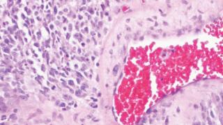 Microscope View of Oncoglioma from Clinical Molecular Diagnostic Laboratory