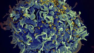 Scanning electron micrograph of HIV particles infecting a human H9 T cell.