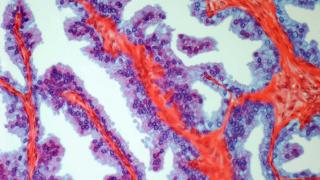 Prostate cancer light micrograph v3