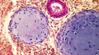 Testicular cancer cells