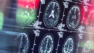 brain scans