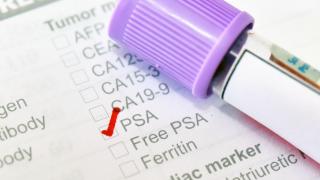 Prostate cancer PSA test