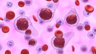 myelofibrosis