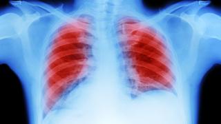Lung cancer scan