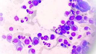 myeloma