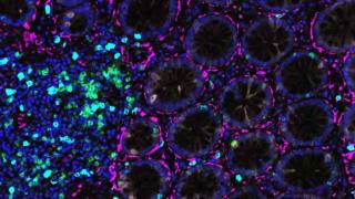Gastrointestinal tumor microenvironments microscopic Purple Cells