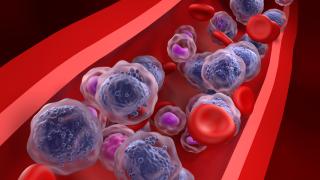 Acute myeloid leukemia illustration