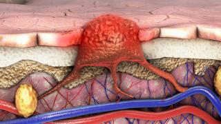 image showing melanoma cancer cells