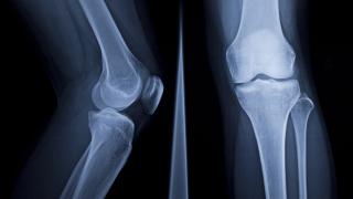 leg xray
