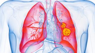 lung cancer