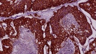 A malignant tumor identified as adenocarcinoma