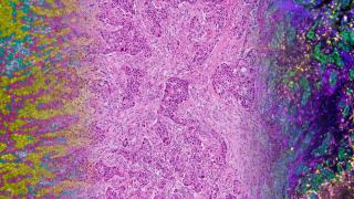 Three blended microscope images of one cancer tissue.