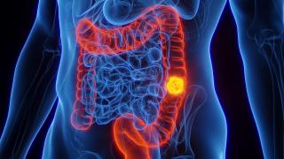 Colorectal cancer screening image