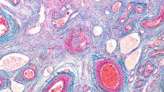 How FRα testing is expanding treatment options for ovarian cancer
