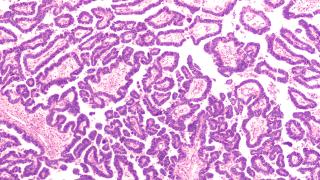 Platinum resistant ovarian cancer cells under microscope