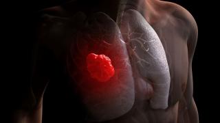 3D rendering of lung cancer cells in a man's chest