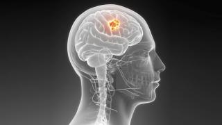 Brain Tumor 