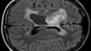 Leo Wang Research Pediatric Brain Tumor