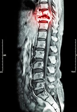 dual-spinal-surgery-thoracic-cancer-image
