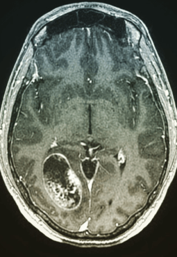 stacy-kimmel-brain-mri