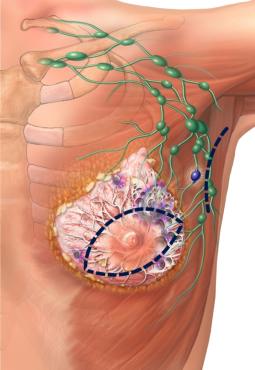 Illustration of two common incisions used in the excision of the tumors in the breast and axillary lymph nodes.