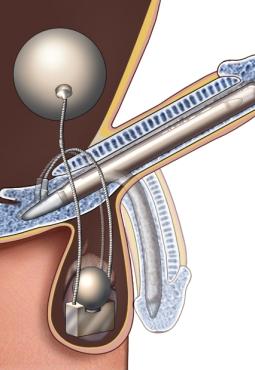 Medical illustration shows a penile implant located in the copus spongiosum tissue of the penis.