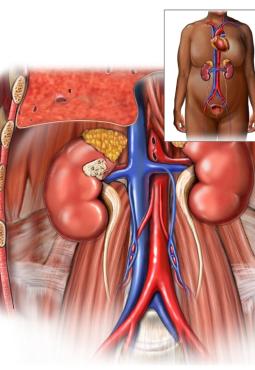 An illustration of renal cell carcinoma mass within the mid-portion of the right kidney.