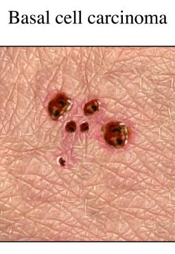 An illustration of a  patch of skin with multiple basal cell carcinoma lesions 
