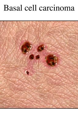 An illustration of a patch of skin with multiple basal cell carcinoma lesions